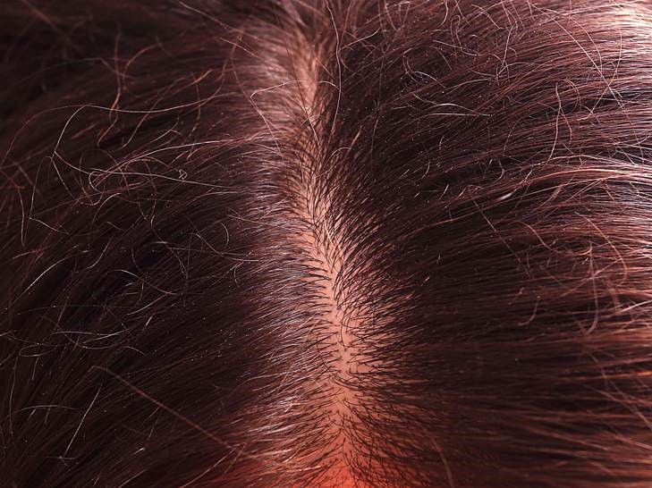 Can a burn cause alopecia?