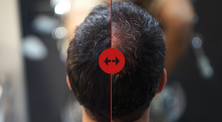 Botox Hair Treatment: Benefits, Side Effects, Price & More