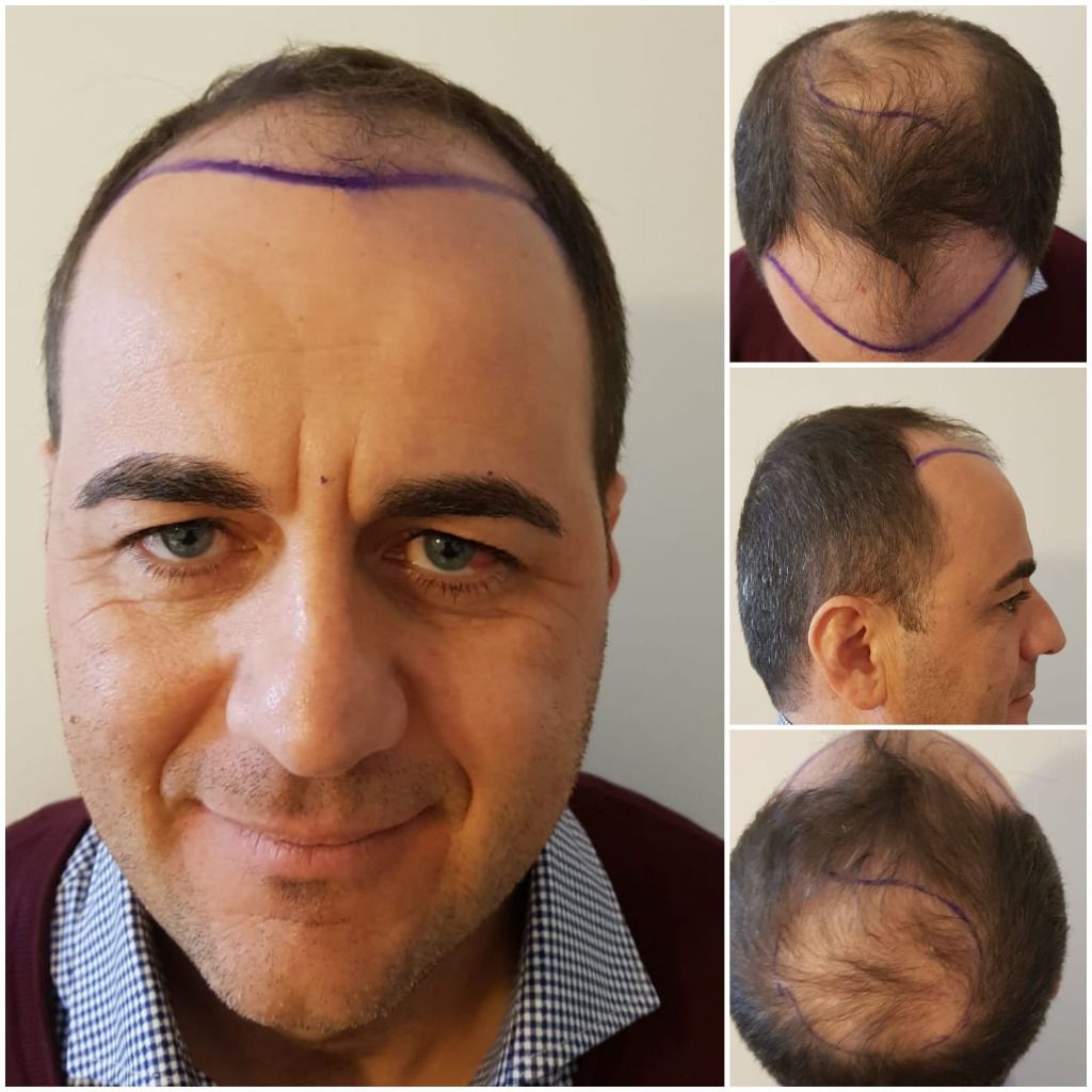 Best Hair Transplant Doctor in India  Dr Suneet Soni