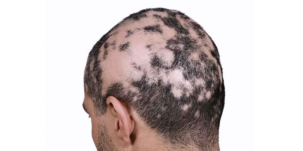 frecuencia Descodificar Capitán Brie TIPOS DE ALOPECIA EN HOMBRES