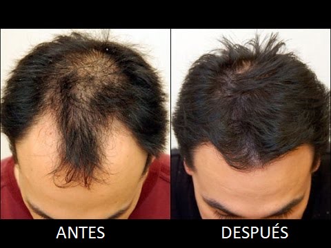 Shop Peptides For Hair Growth | UP TO 58% OFF