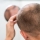 ¿Hay alguna solución para hacer crecer el pelo en zonas calvas?