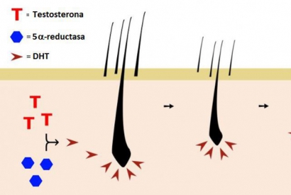 Getting to know the hair loss process: the role of the 5-reductase enzyme