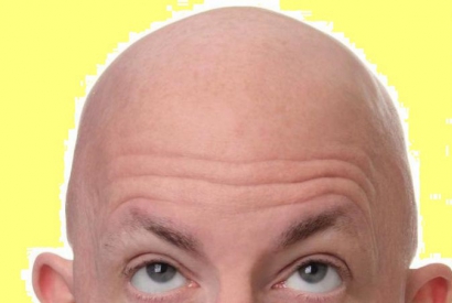 Can a burn cause alopecia?