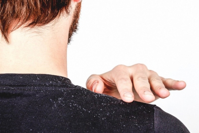 How is dandruff removed?