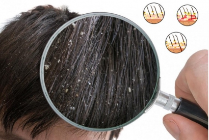 What is dandruff? What types of dandruff are there?