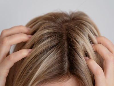 Caspa seca: causas, tratamiento y prevención