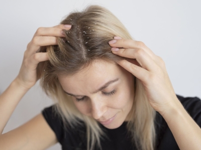 Caspa grasa: causas,  tratamientos efectivos y prevención