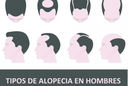 TIPOS DE ALOPECIA EN HOMBRES
