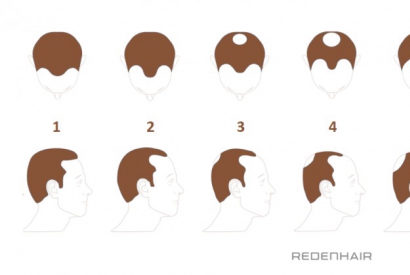 La escala de Hamilton-Norwood en la alopecia androgénica