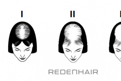 The Ludwig scale for female androgenetic alopecia (female pattern hair loss)